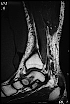 MRI TA rupture chronic